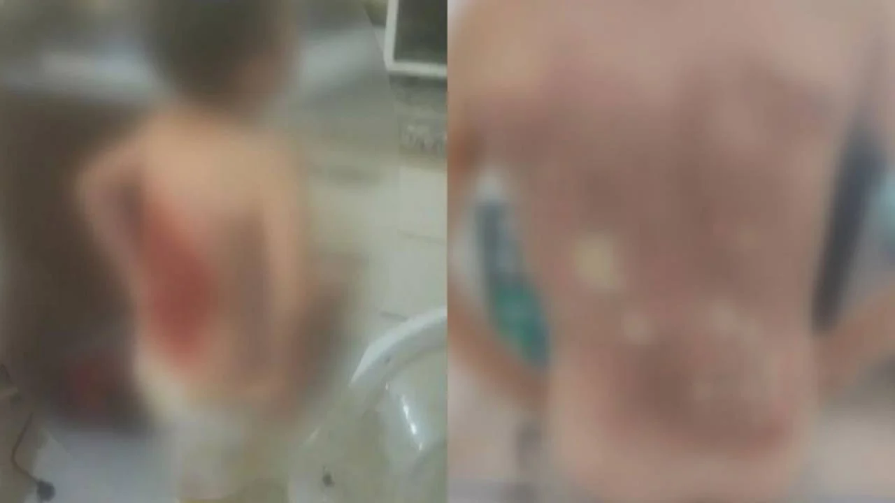 Arnavutköy’de akran şiddeti: 12 yaşındaki çocuğu kolonya döküp yaktılar