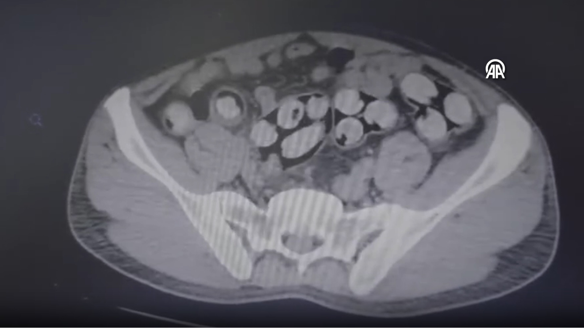Tam 139 kapsül! Tomografide ortaya çıktı